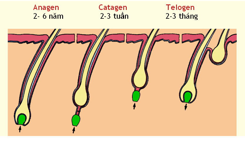 Hói đầu di truyền