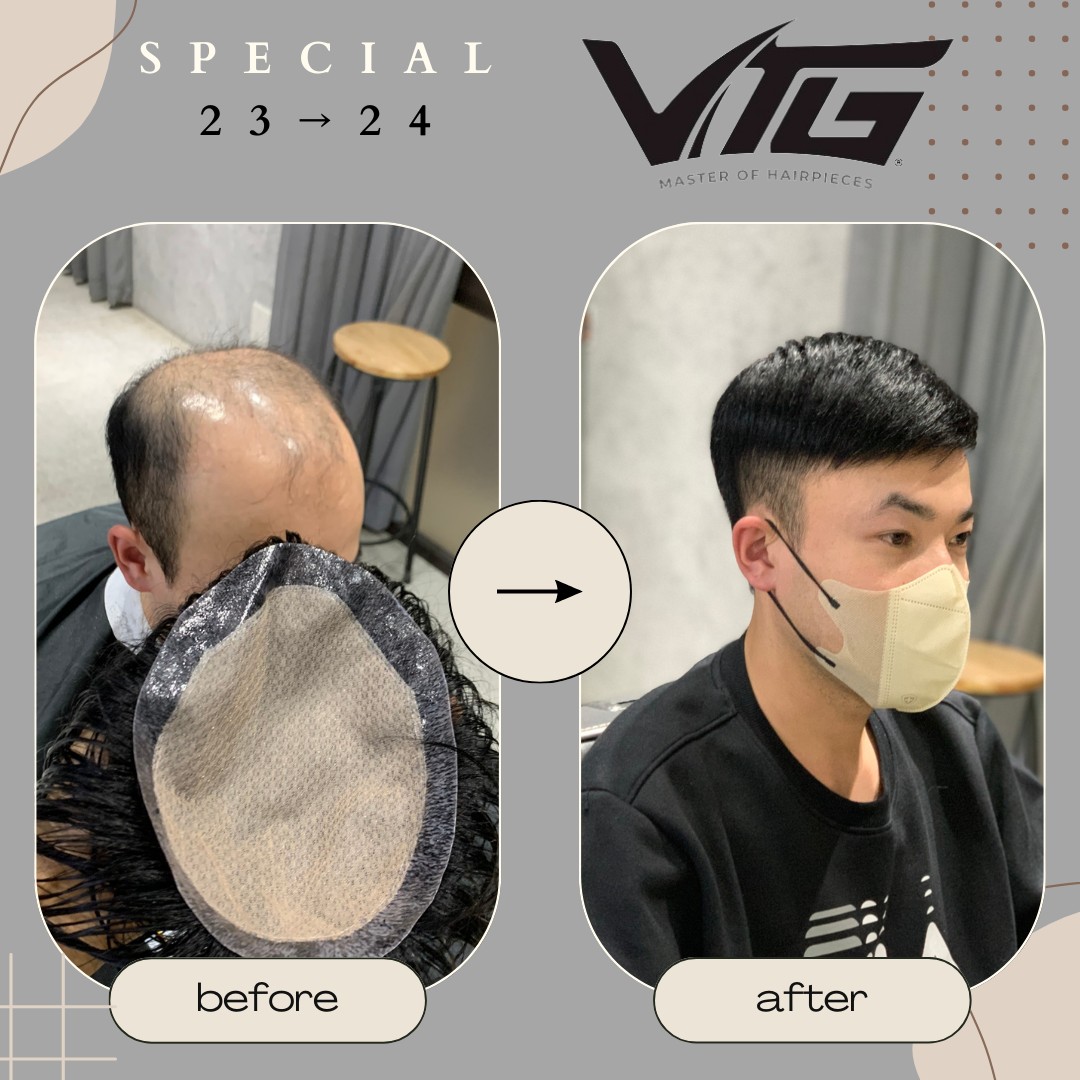 Tóc giả nam topper che phủ vùng hói đỉnh đầu và được cố định bằng kẹp vào tóc thật