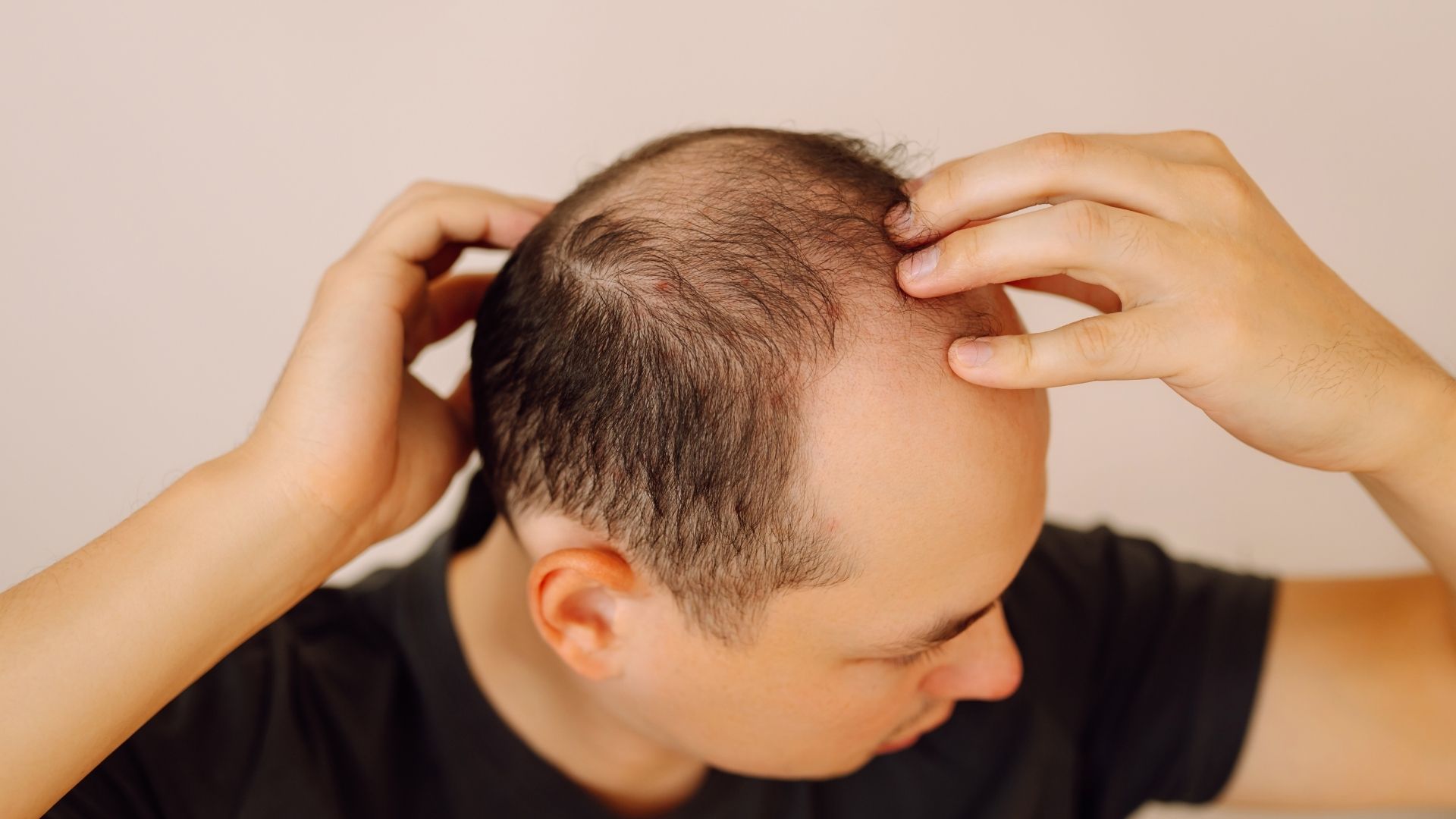 Nam giới cần kiểm tra tình trạng da đầu sau khi sử dụng tóc giả cố định bằng keo dán